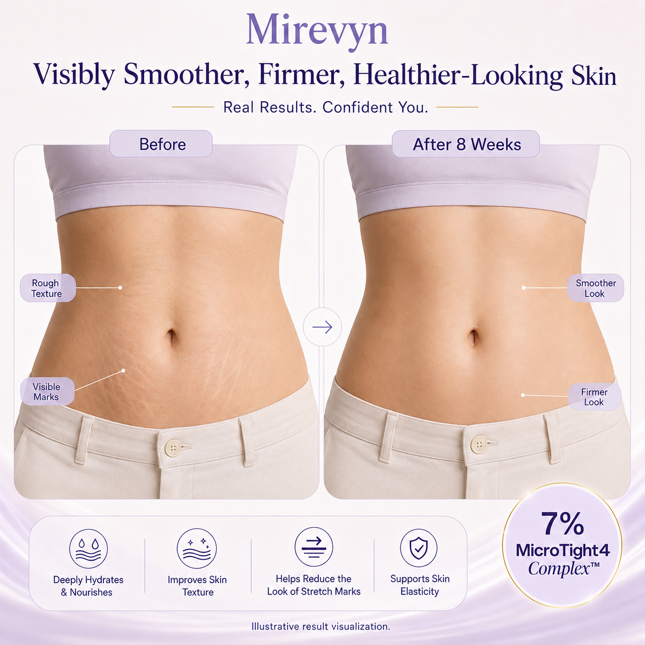 ✨ Reveal Firmer, Smoother-Looking Skin with Mirevyn Belly Cream